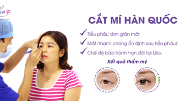 Cắt mí Hàn Quốc
