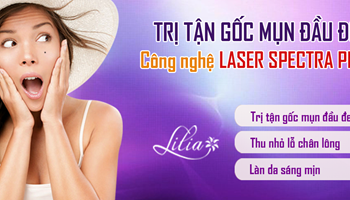 Trị mụn đầu đen công nghệ Laser Spectra 