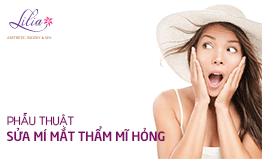 Sửa mí mắt thẩm mỹ hỏng