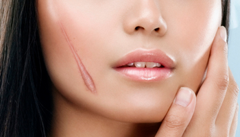 Sẹo lồi lâu năm – làm sao để hết?