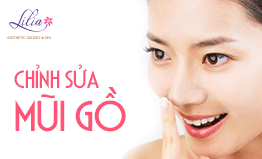 Chỉnh hình mũi gồ 