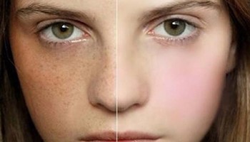 Trị nám da ở đâu hiệu quả?