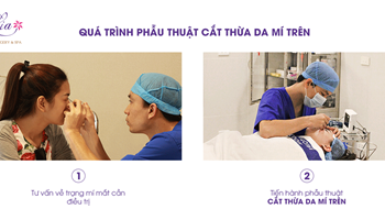 Tìm hiểu về quy trình tiến hành cắt da thừa mí mắt trên