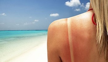 Da bị cháy nắng phải làm sao?