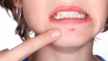 Trị mụn bọc ở đâu tốt nhất hiện nay?