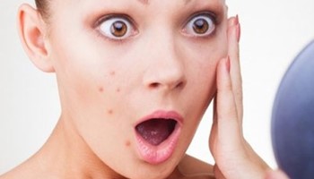 Làm thế nào để mụn cóc không mọc lại?