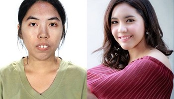 10 màn lột xác gây chấn động giới phẫu thuật thẩm mỹ
