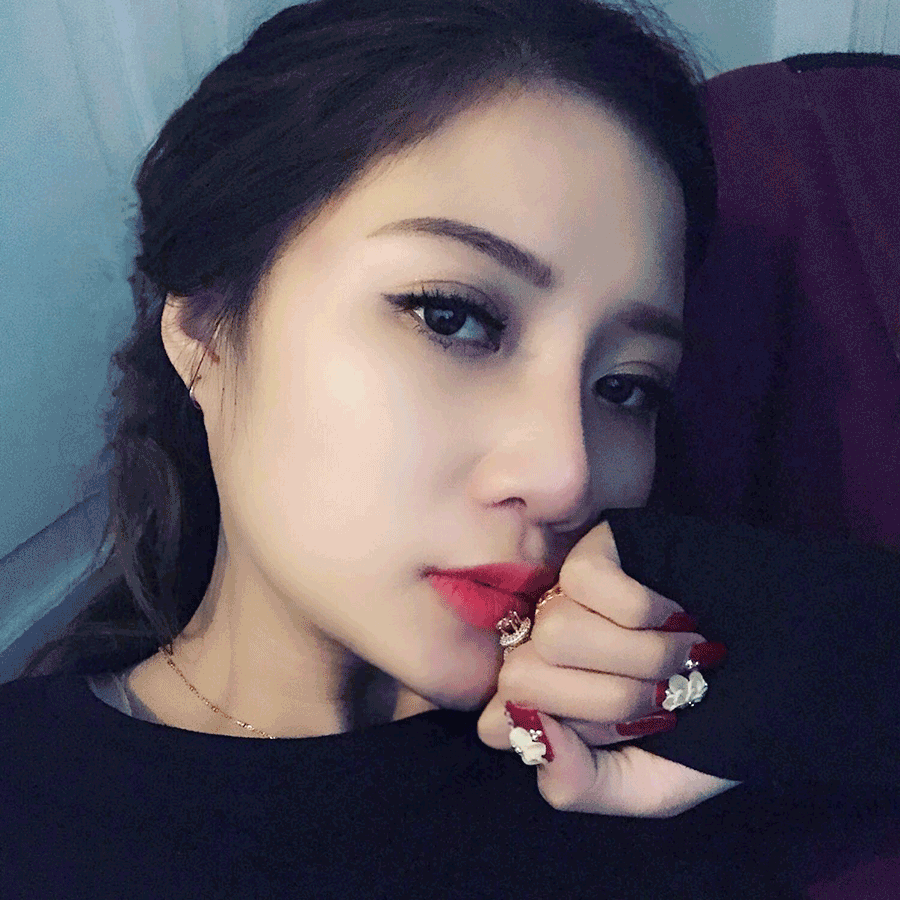 Khách hàng Dương Anh – Nâng mũi Megaline 5D