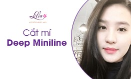 CẮT MÍ DEEP MINILINE – MẮT 2 MÍ ĐẸP RẠNG NGỜI 