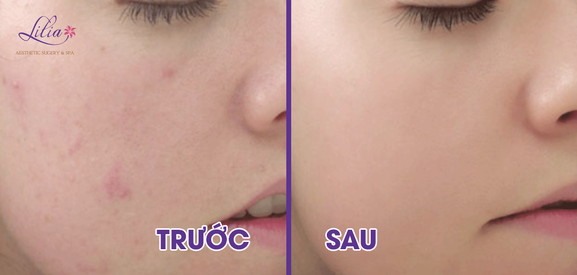 Trị mụn trứng cá hiệu quả