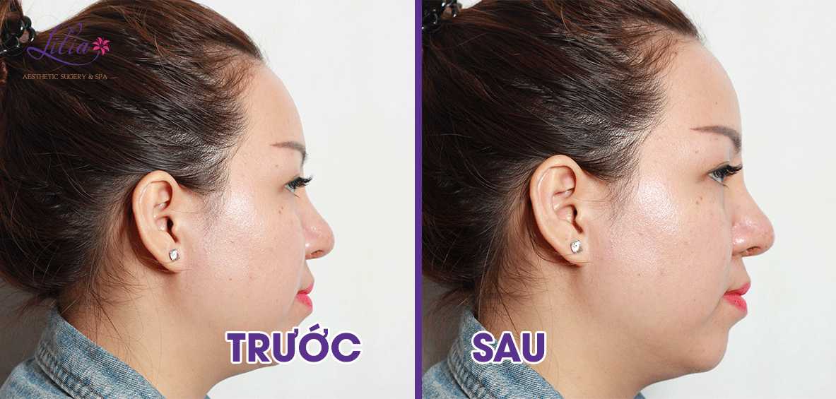 nâng mũi không phẫu thuật filler