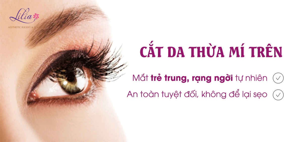 Cắt da thừa mí mắt trên