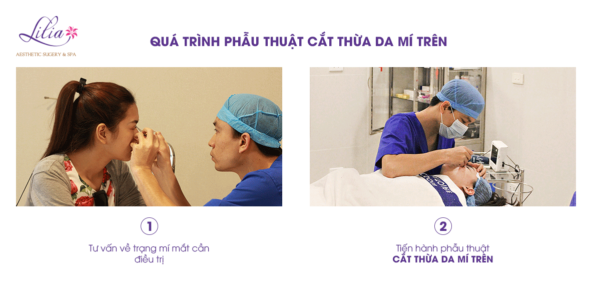 Cắt da thừa mí mắt trên