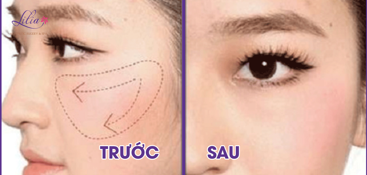 nâng cao gò má filler