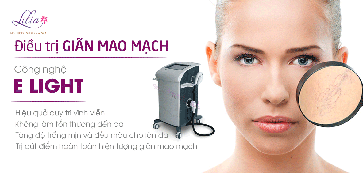 Điều trị da giãn mao mạch công nghệ E-light