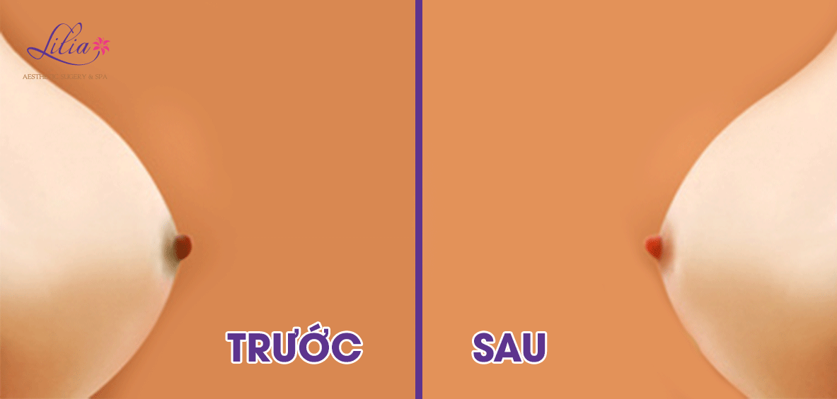 Phun xăm nhũ hoa công nghệ cao