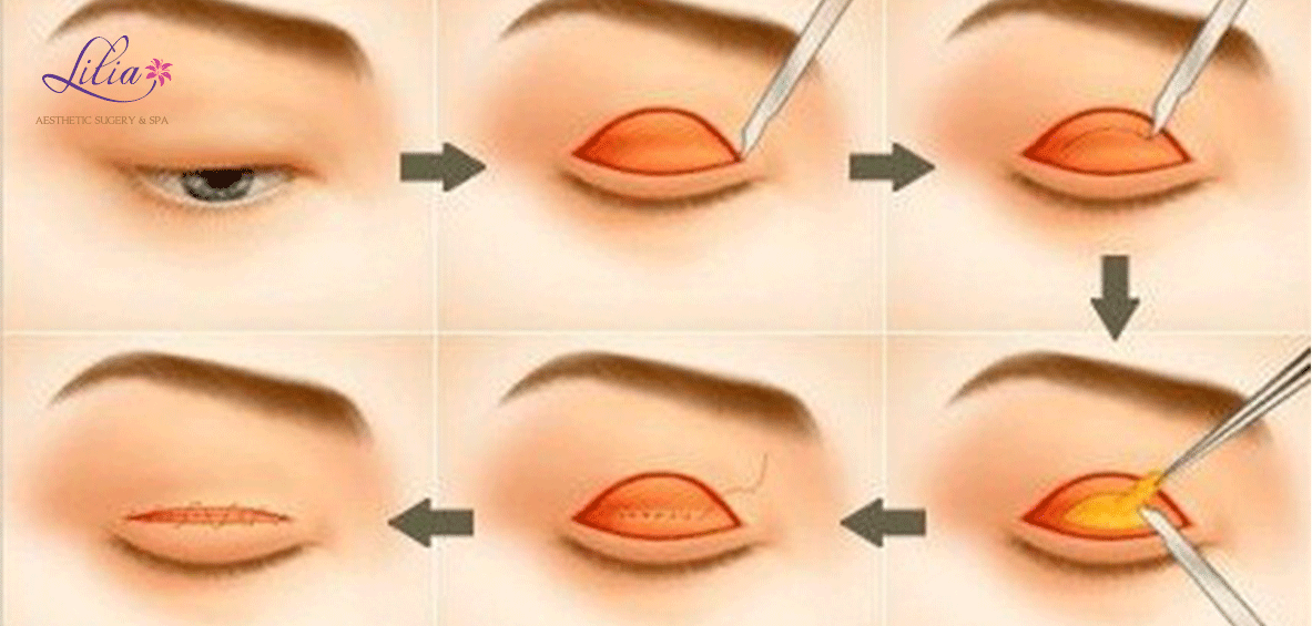 Lấy mỡ mí mắt trên