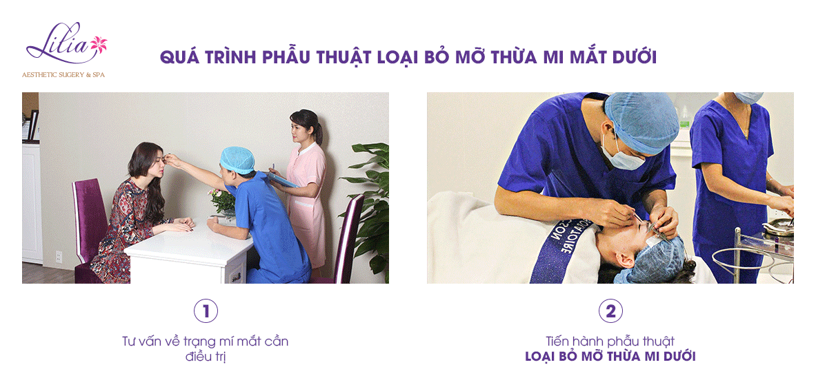 Lấy mờ thừa mí mắt dưới 