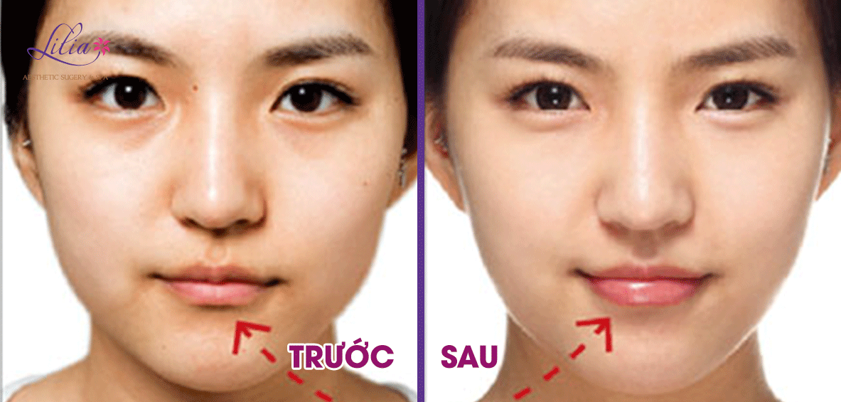 Phẫu thuật môi cười