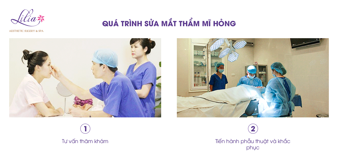 Sửa mí mắt thẩm mỹ hỏng