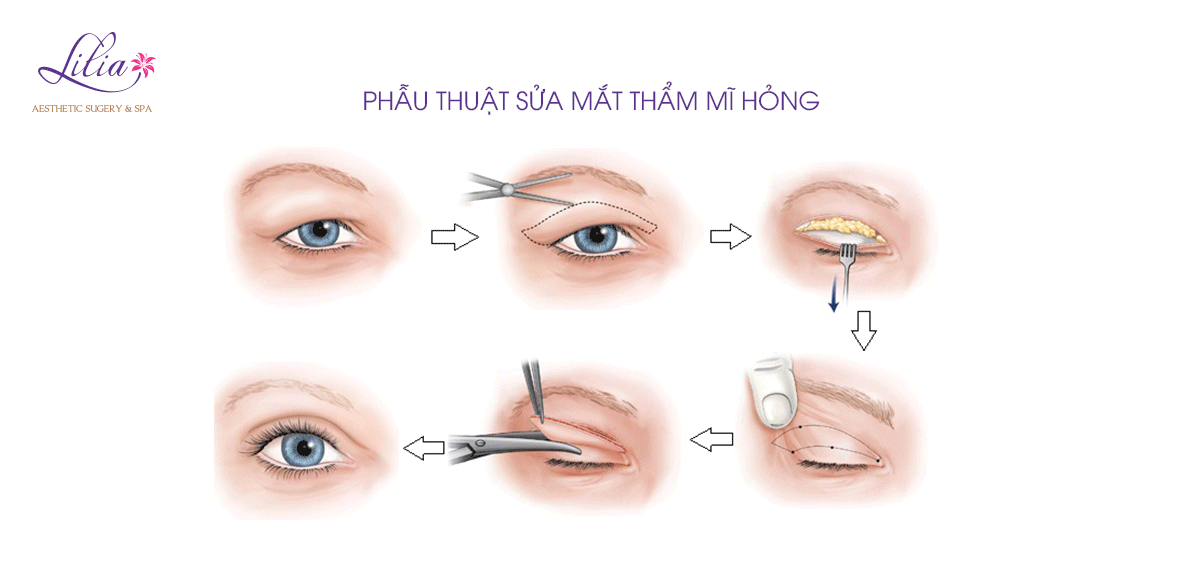 Sửa mí mắt thẩm mỹ hỏng
