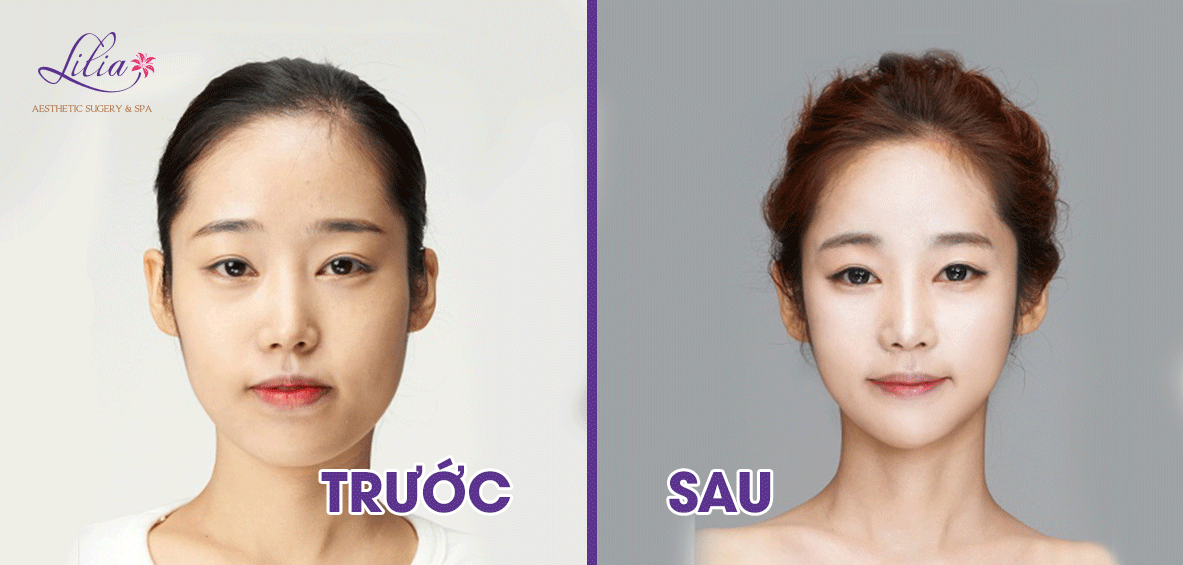 độn cằm