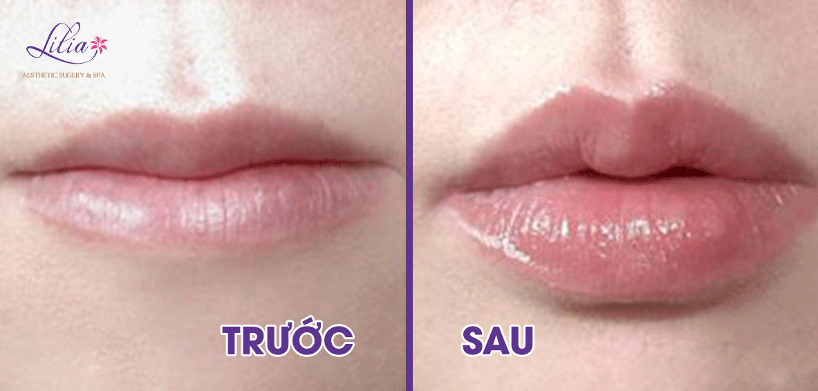 Thu hẹp góc miệng hai bên