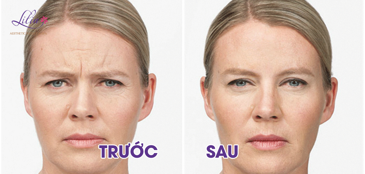 Xóa nếp nhăn trên mặt