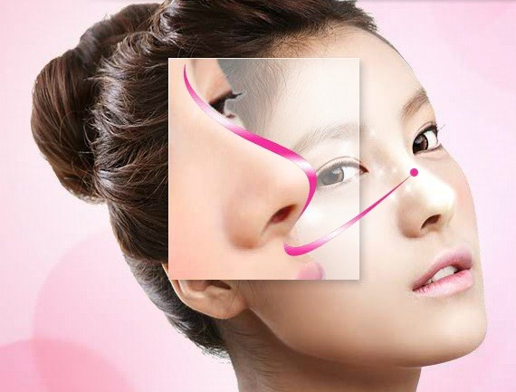nâng mũi không phẫu thuật
