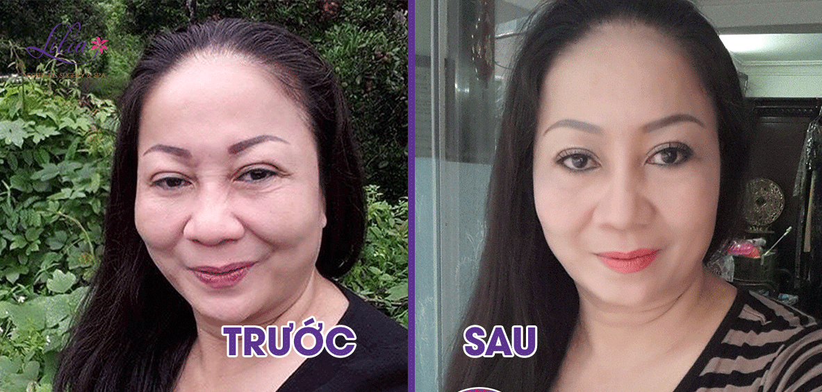 Trẻ hóa da, xóa nhăn, nâng cơ công nghệ Ultraformer HIFU