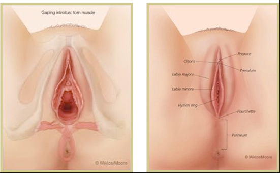 thu nhỏ âm đạo công nghệ matrixell