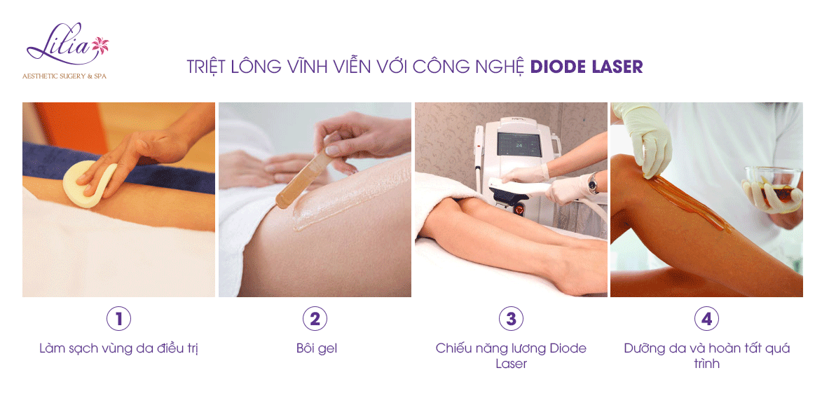 Triệt lông vĩnh viễn công nghệ Diode Laser