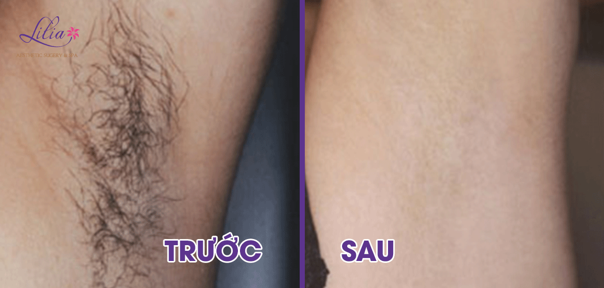 Triệt lông vĩnh viễn công nghệ Diode Laser