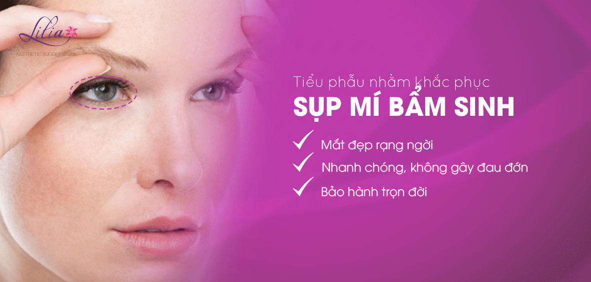 Sụp mí bẩm sinh
