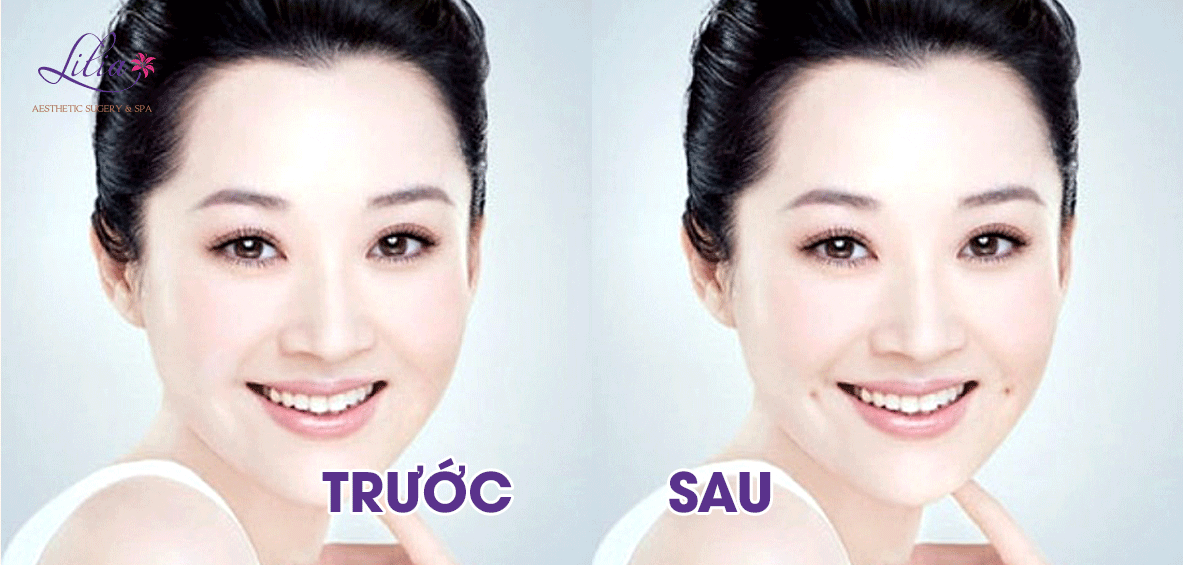 Tạo má lúm đồng tiền