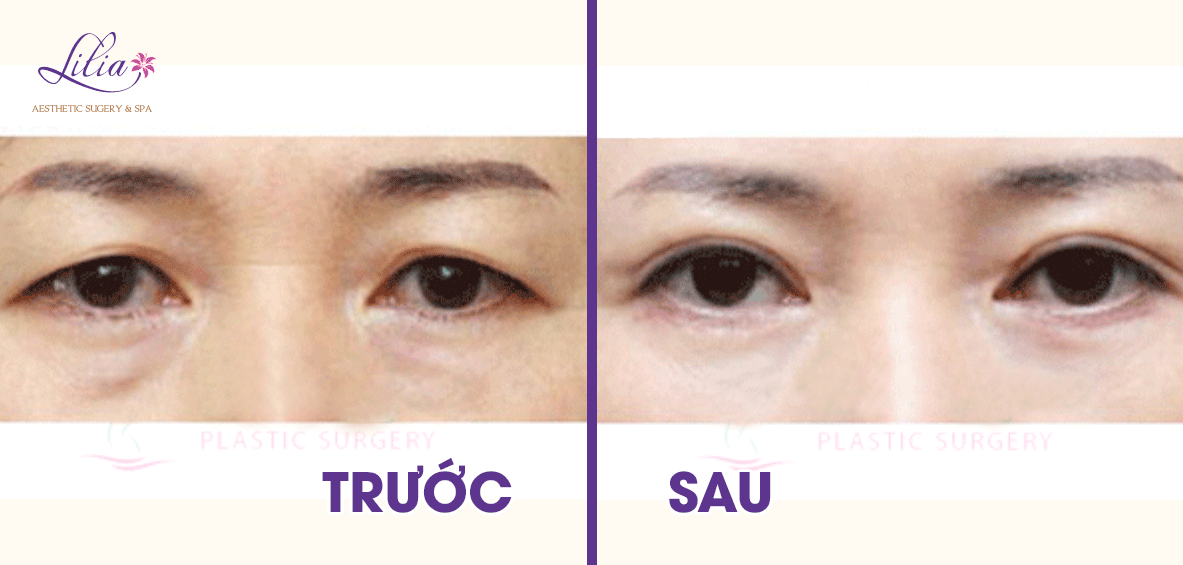 Tạo hốc mắt sâu