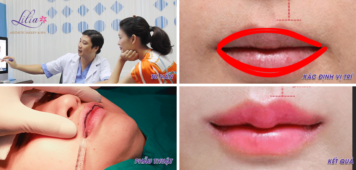 Tạo hình môi trái tim