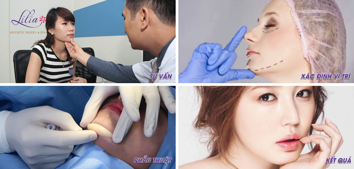 Tạo cằm chẻ 