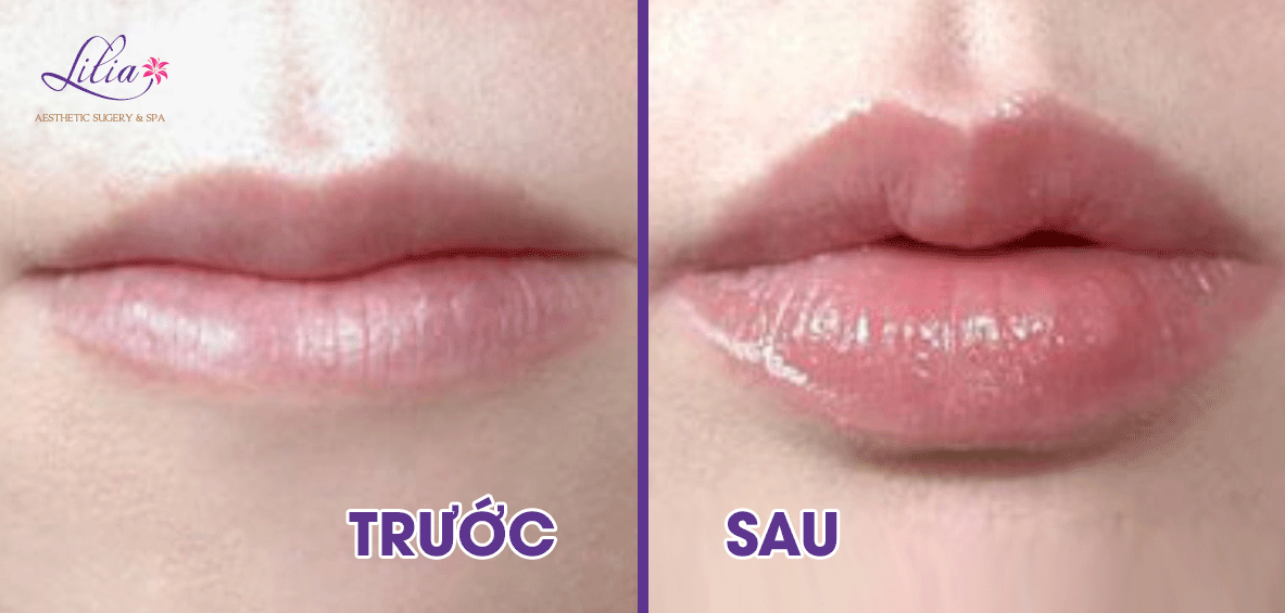 Phẫu thuật thu mỏng môi