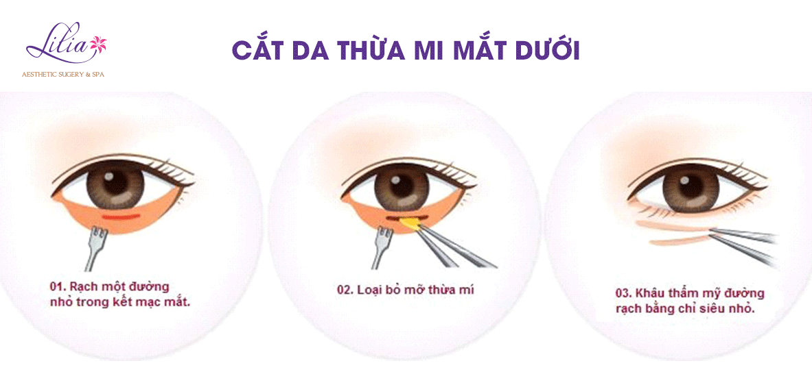 Cắt da thừa mí mắt dưới