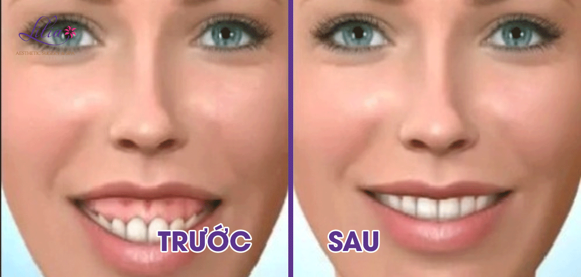 Phẫu thuật chữa cười hở lợi