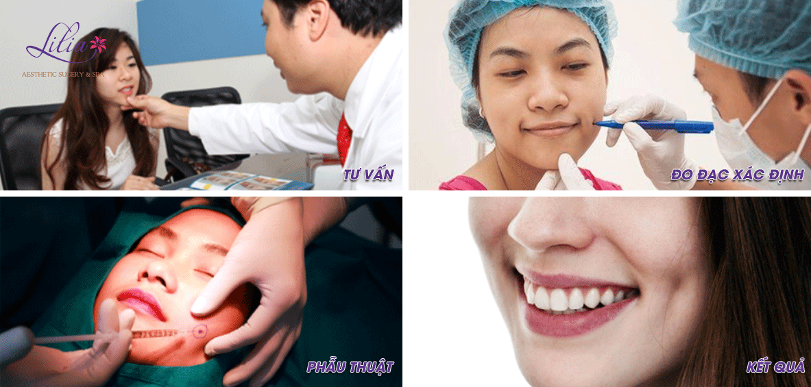 Tạo má lúm đồng tiền