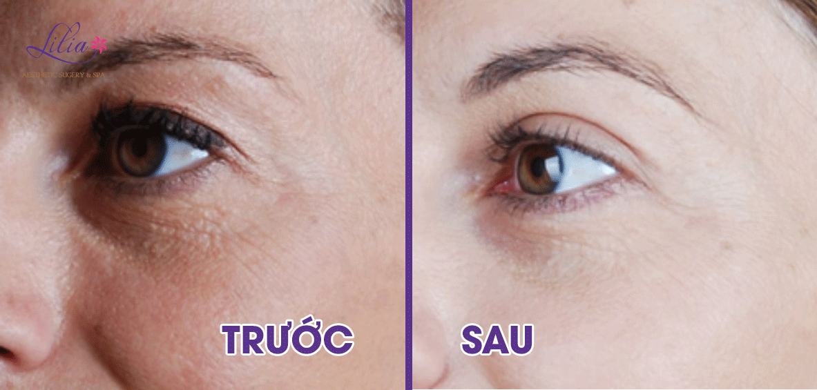 Tạo hốc mắt sâu