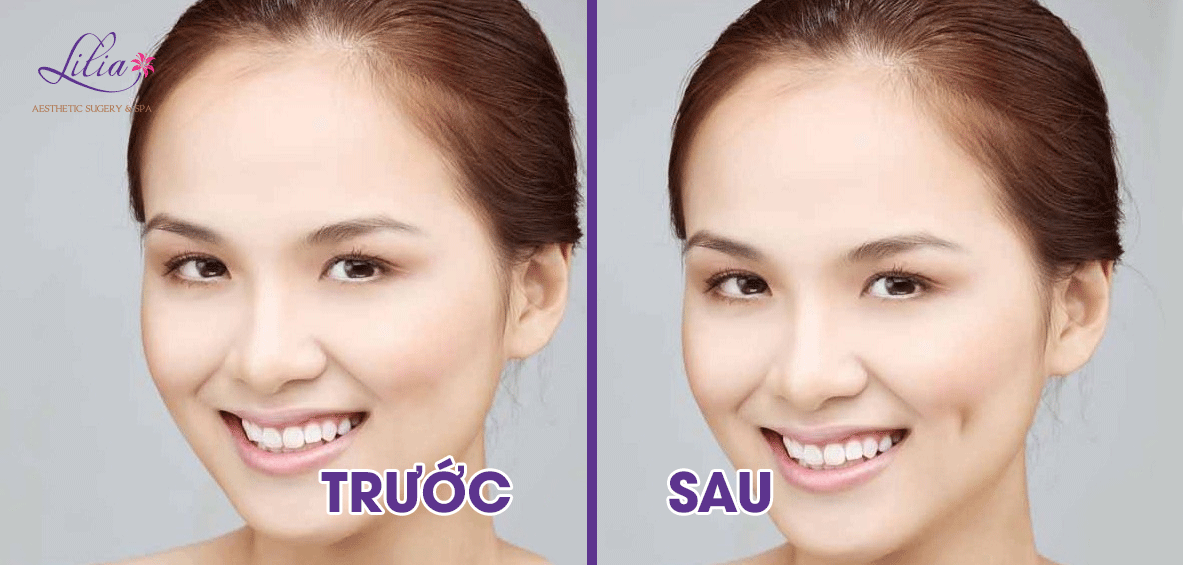 Tạo má lúm đồng tiền