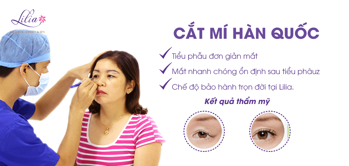 cắt mí hàn quốc