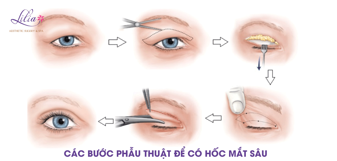 Tạo hốc mắt sâu