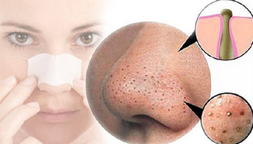 Bật mí cách trị mụn đầu đen ở mũi tận gốc hiệu quả 100%