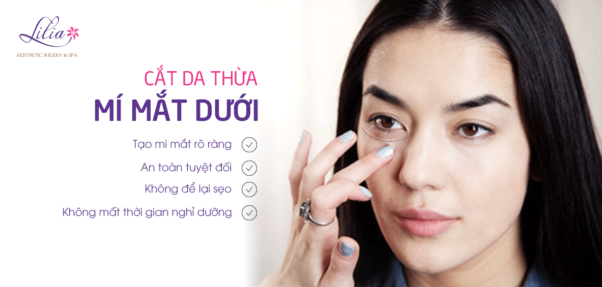 Cắt da thừa mí mắt dưới