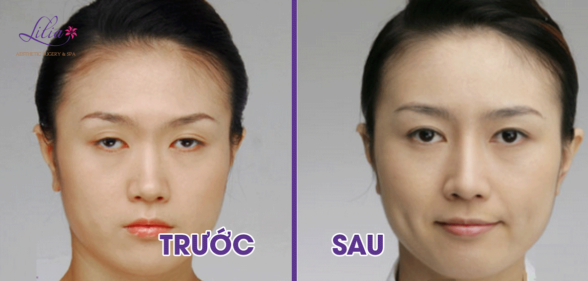 Sụp mí bẩm sinh