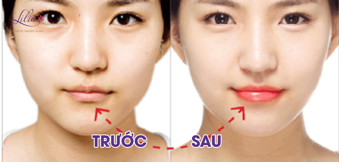 Phẫu thuật thu mỏng môi